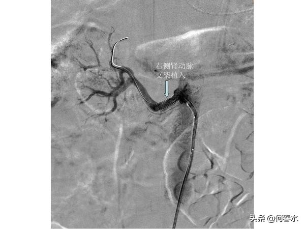 颈动脉狭窄介入治疗,颈动脉狭窄介入手术多少钱