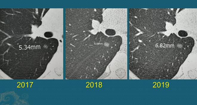7mm磨玻璃结节是手术好还是随访好,5mm磨玻璃结节可以随访吗