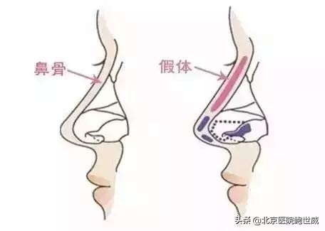 隆鼻为什么会假体外露,假体隆鼻外露怎么修复