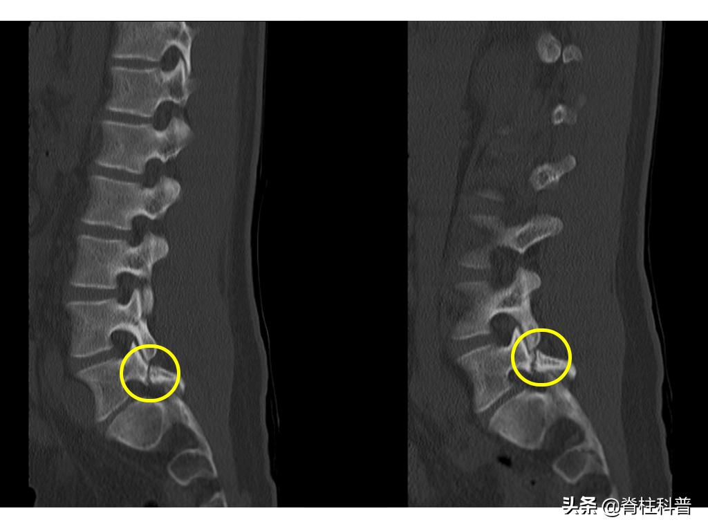 腰痛引起腰椎滑脱怎么治,十七岁腰椎痛怎么办