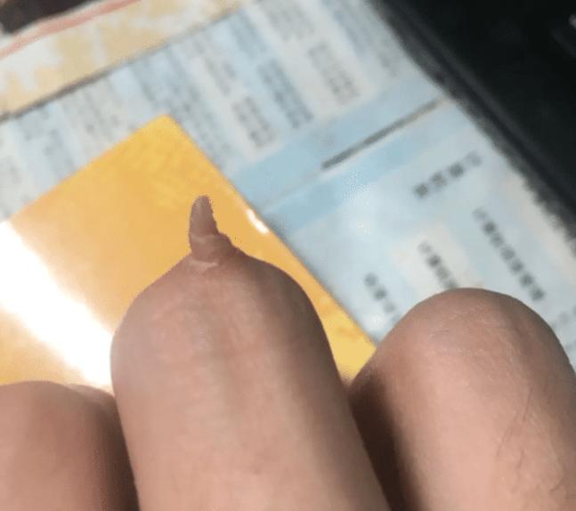 中指关节处有死肉,中指长了一个肉球