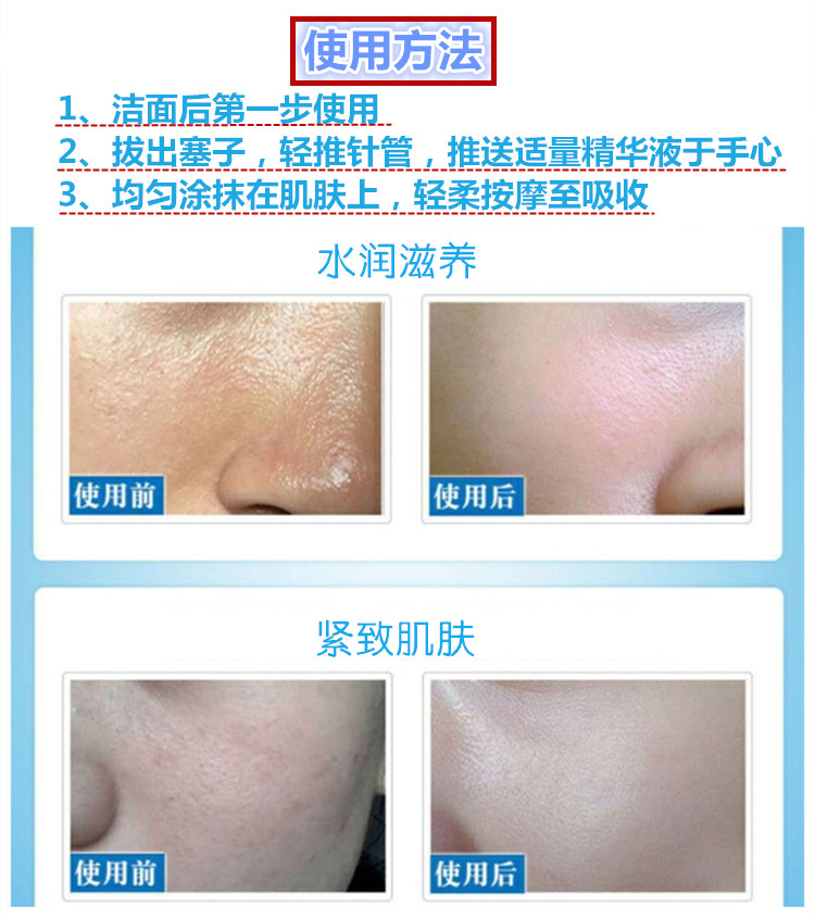 打玻尿酸消除皱纹效果怎么样,涂抹式玻尿酸可以去皱纹吗