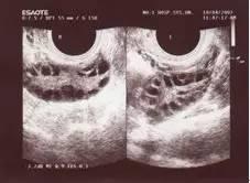 多囊卵巢综合征是什么症状啊,多囊卵巢综合征的症状和危害