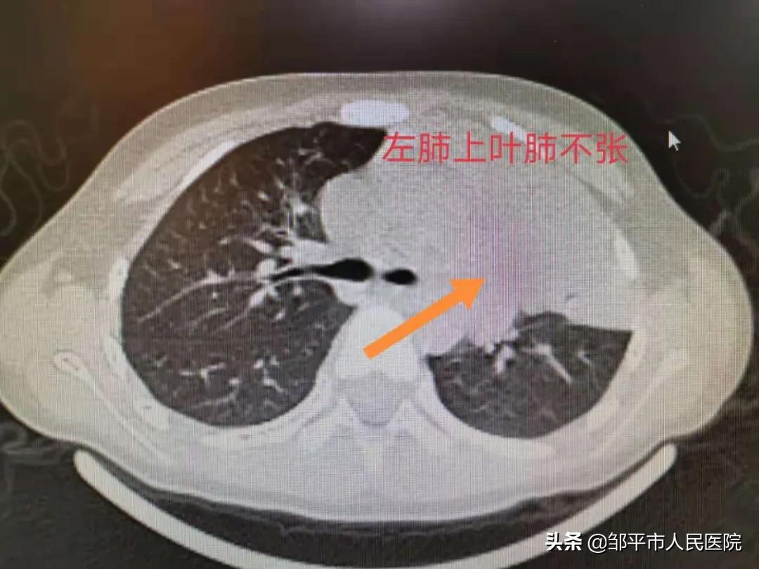 重症肺炎最佳治疗方法,满月宝宝重症肺炎如何治疗