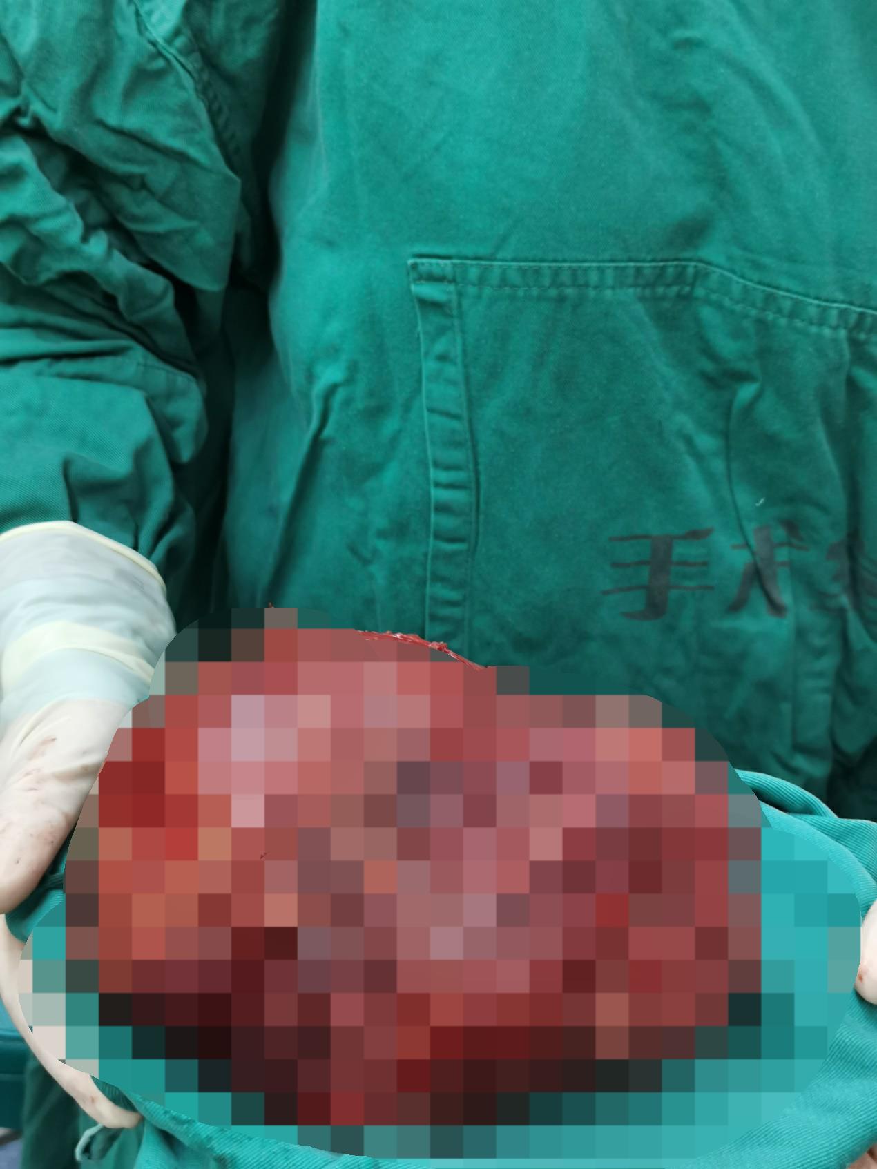 巨大肿瘤切除手术生命缘,巨大肿瘤被医生成功切除