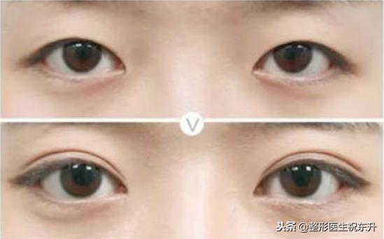 关于单眼皮整双眼皮的咨询话术,无痕双眼皮闭眼有肉条
