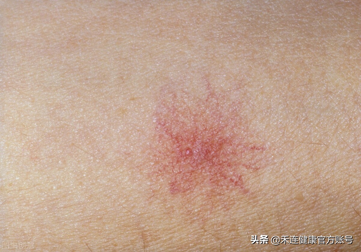 身上长小红点是肝不好吗,肝出什么问题身上会有小红点