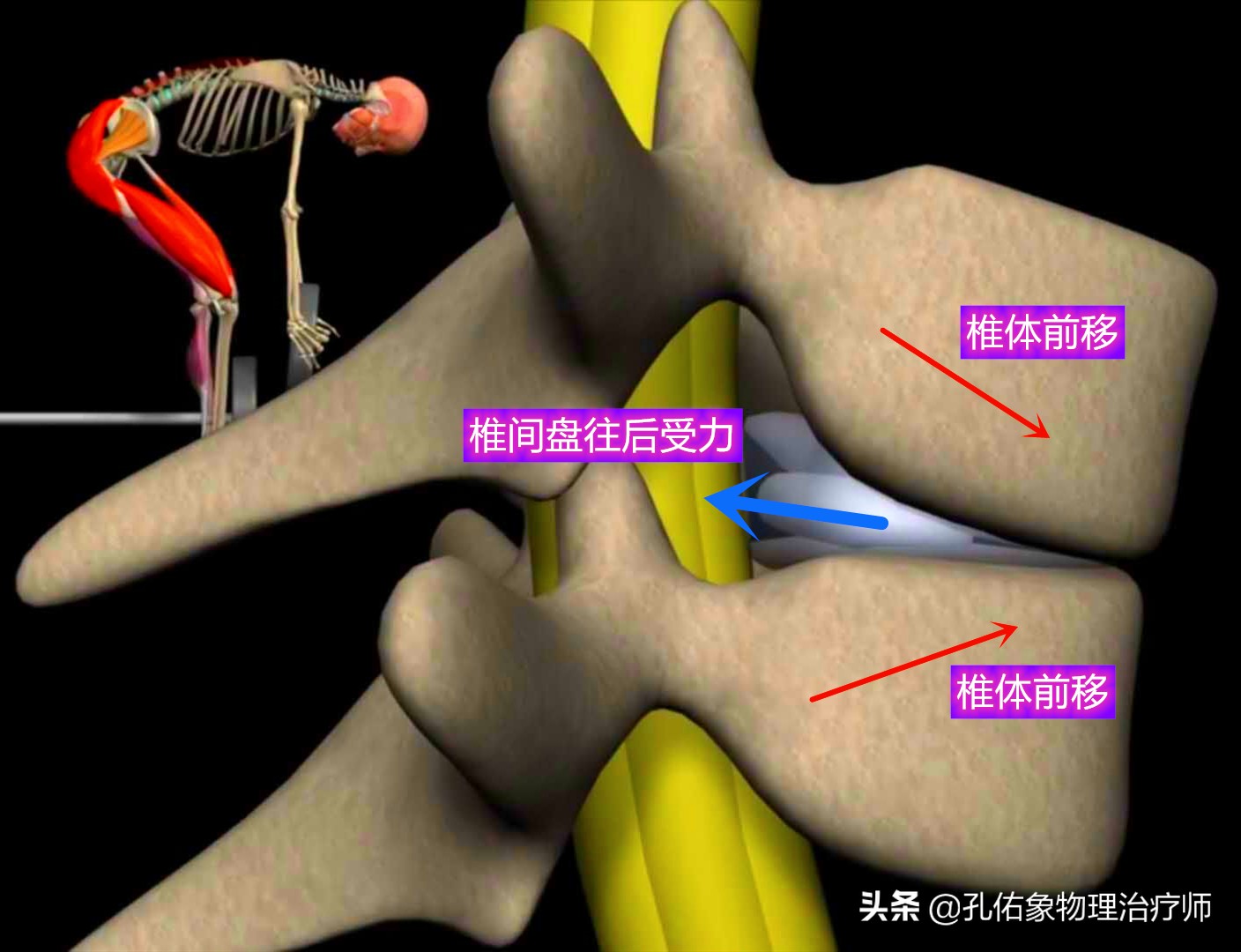 腰椎间盘膨出最佳消除方法是什么,有腰椎间盘突出不知该怎么治疗