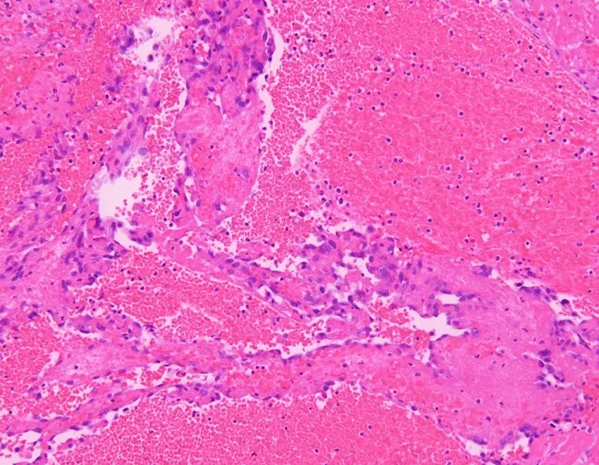 弥漫性肺泡出血是怎么回事,弥漫性肺泡出血症病因分类