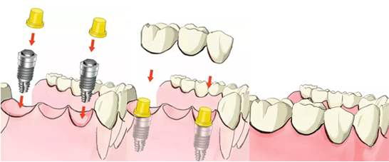 烤瓷牙桥适用于什么,烤瓷桥好处