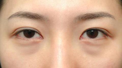 45岁女人适合做哪种祛眼袋方法,生姜祛眼袋的正确方法