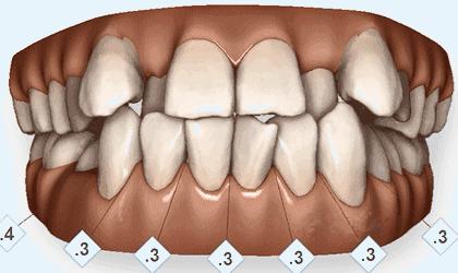 八岁孩子牙齿不齐用什么矫正,十岁小孩牙齿不齐需要矫正吗