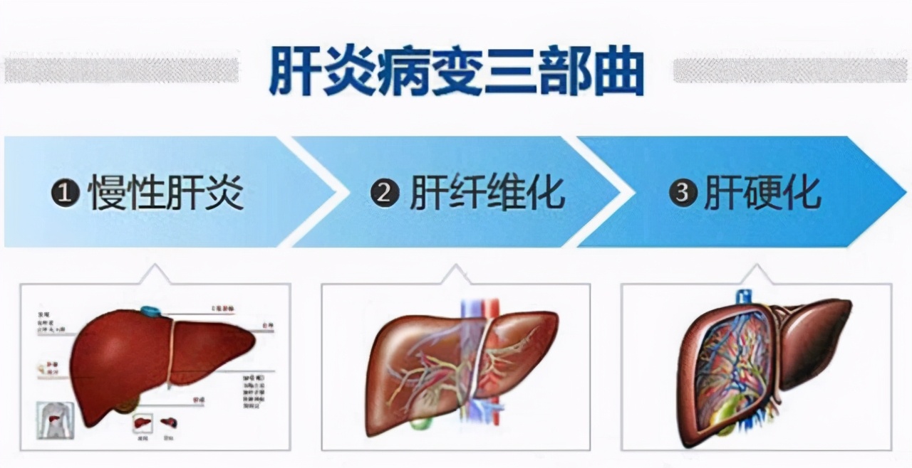 患有乙肝，一直不吃药也不治疗，最后会怎样？