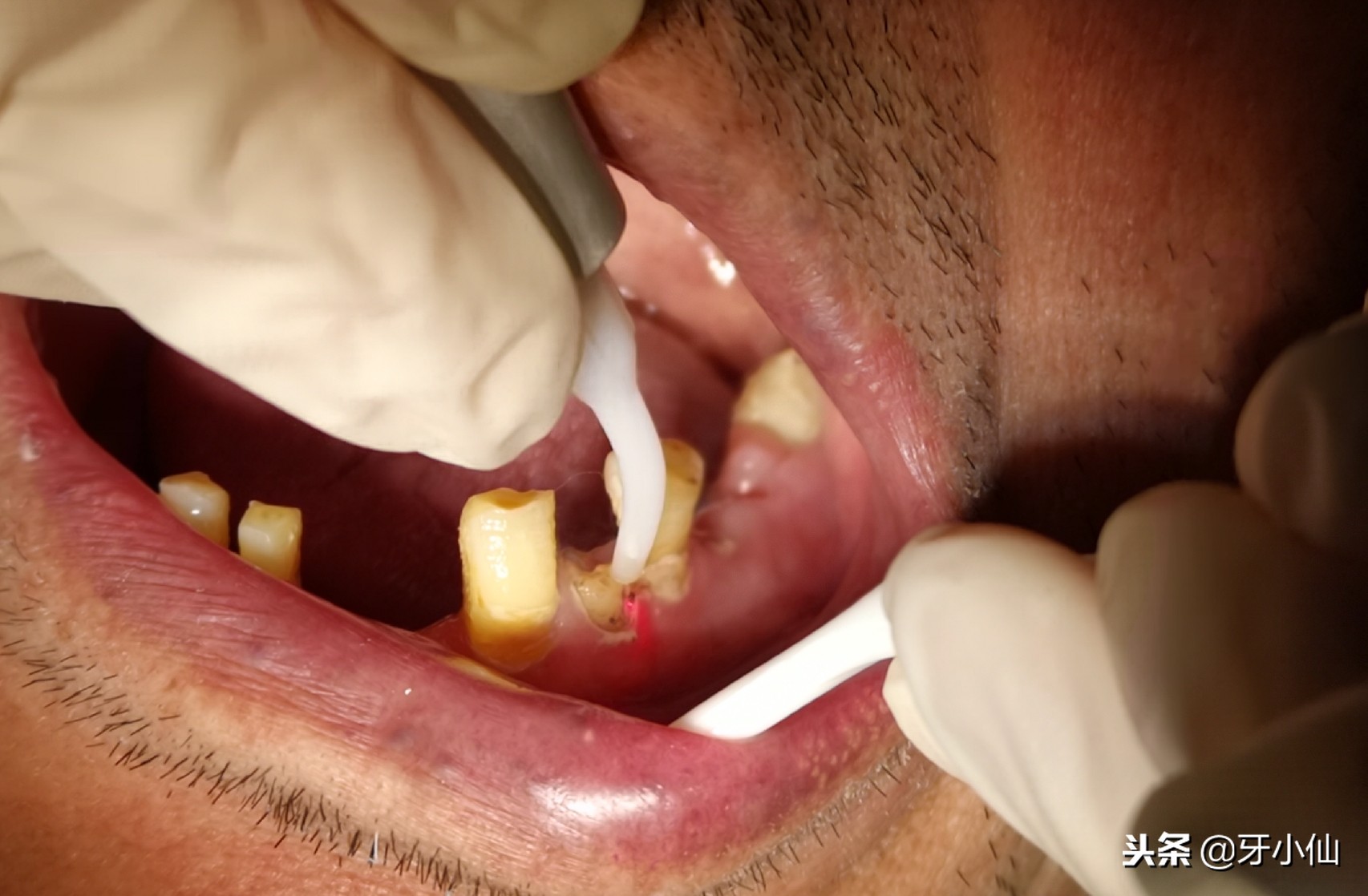 拔牙到底疼不疼几分钟能搞定,拔牙后很疼是伤到牙神经了吗