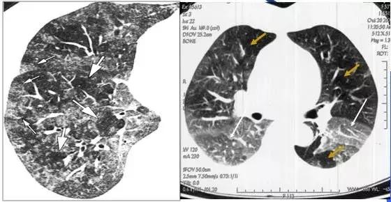 肺部ct十大征象,肺部ct正常图和异常图的区别