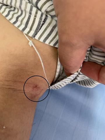 两个针眼便能吸出大腿静脉血栓哈医大一院开展静脉血栓吸除术已成功治愈近200名患者