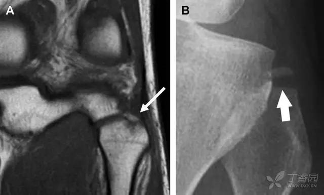 值夜班急救措施,放射科容易漏诊的骨折