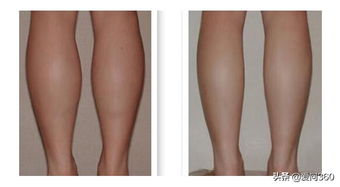 腿部粗壮、腿部肿胀别担心，学会按摩这几个穴位，坚持下去会有效