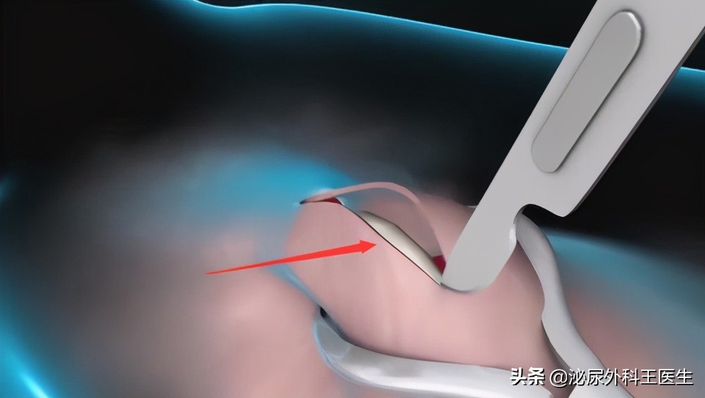 男性做了结扎要注意什么,男性做了结扎会自动复原吗