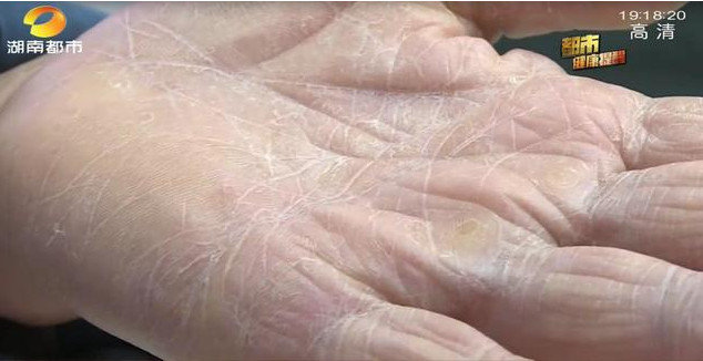 手上皮肤怎么护理,如何护理手背皮肤