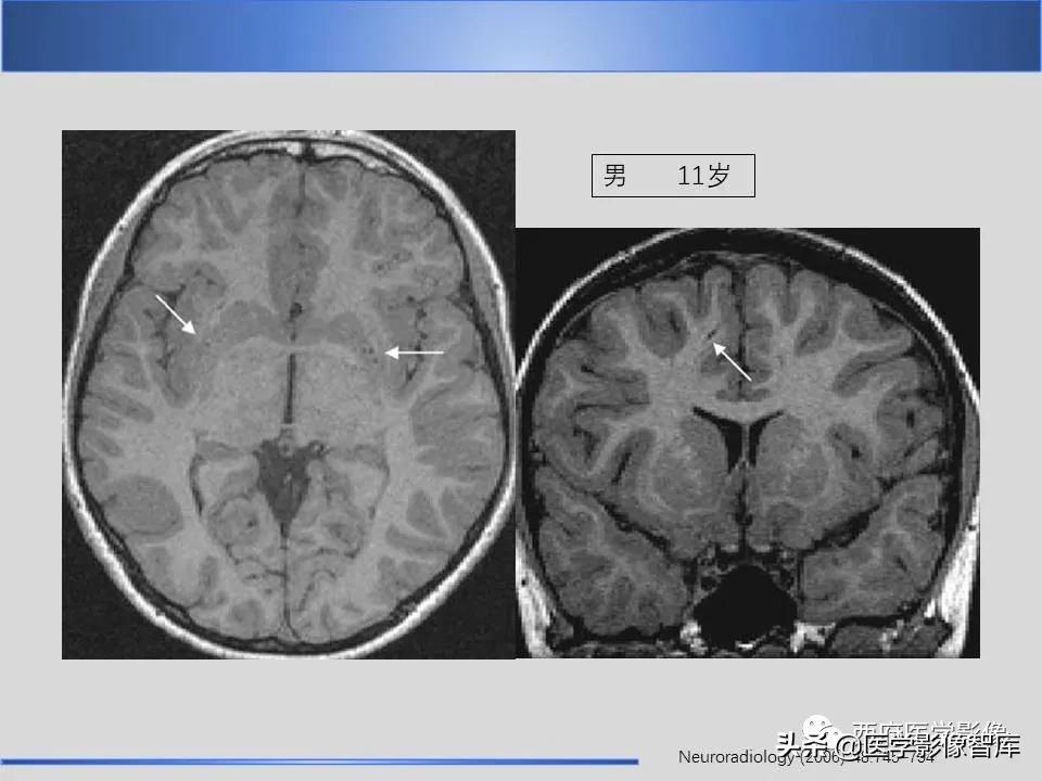vr间隙概念,vr间隙需要做什么检查