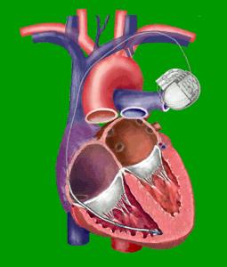 心跳慢安起搏器好吗,心脏跳动慢要用起搏器吗