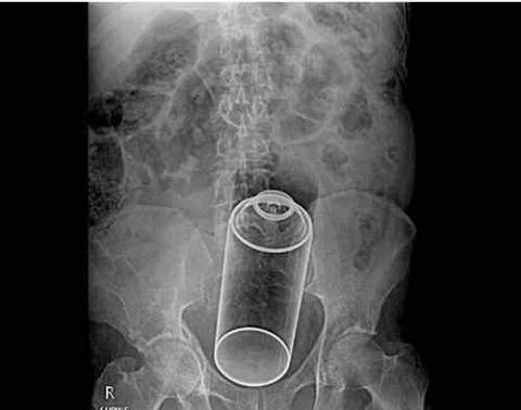 不作死就不会死,看看这些被人类搞进身体里的异物