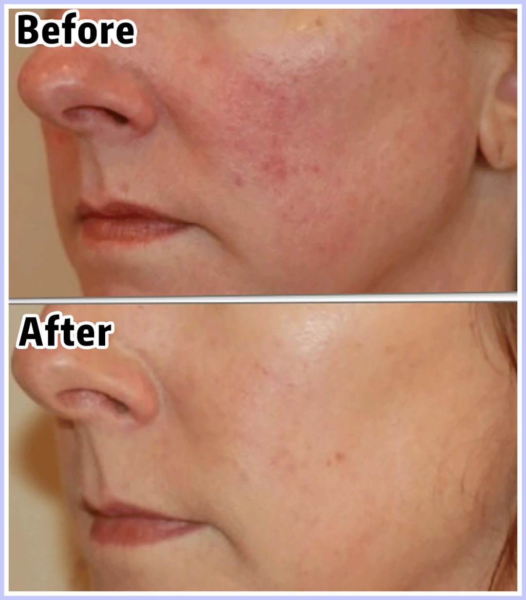 痘印痘坑目前治疗方法哪个最好,医美机构靠药物去痘印痘坑可靠吗