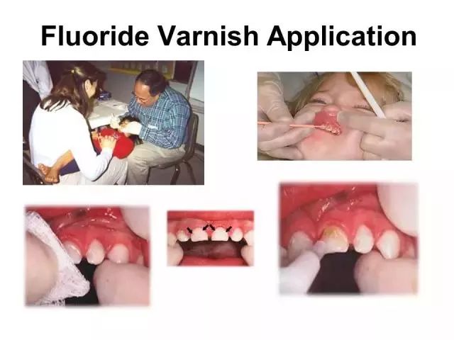 牙齿脱矿白斑怎么修复,牙医修复牙齿漏洞蛀牙全过程