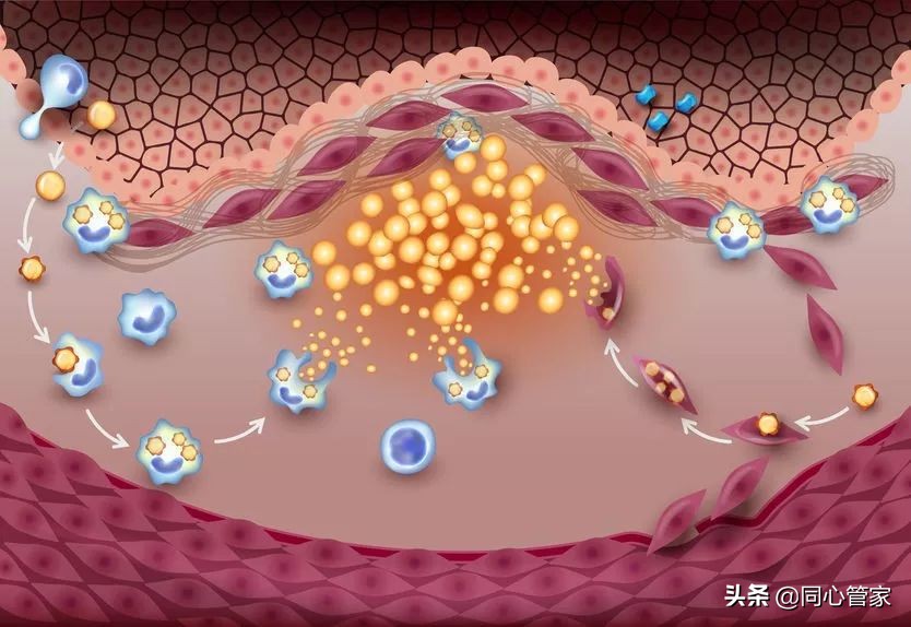 血管狭窄如何扼住生命的咽喉？让你全身器官都遭殃？