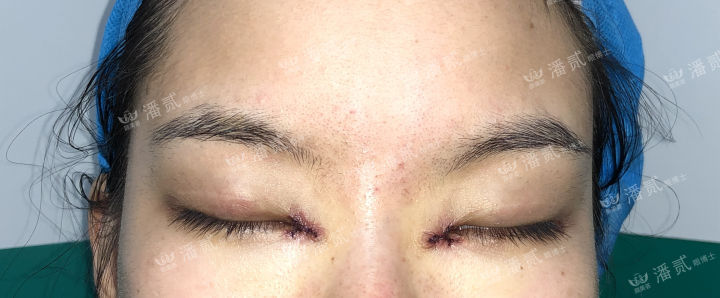 女孩眼部整形失败,内眼角整形失败