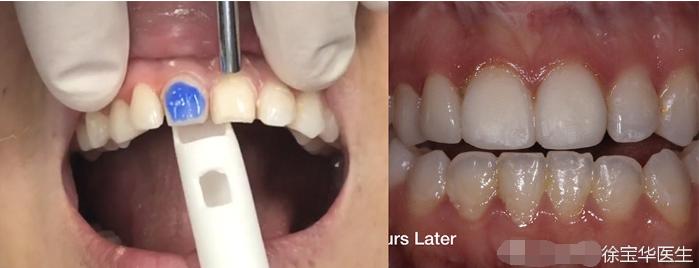 烤瓷牙贴片全口价格,贴片牙齿和烤瓷牙有哪些伤害