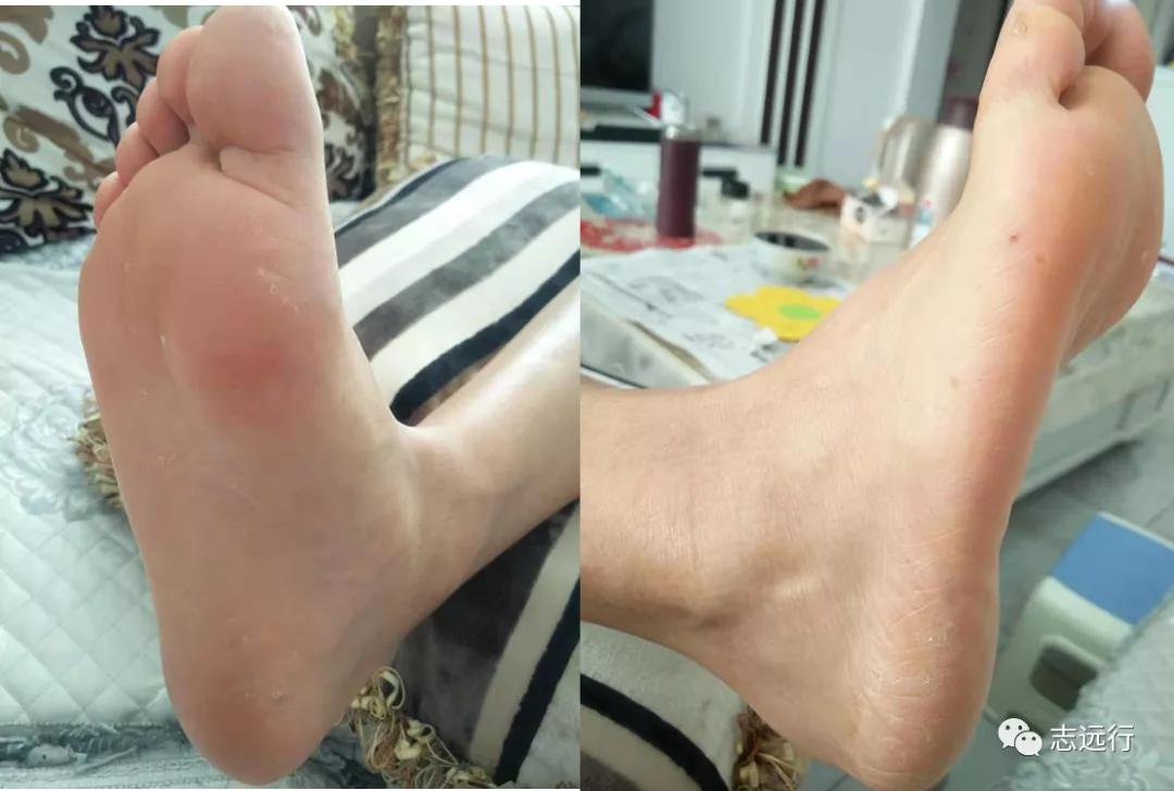 张景明治疗手足癣的中药方,一个治疗手足癣的好方子