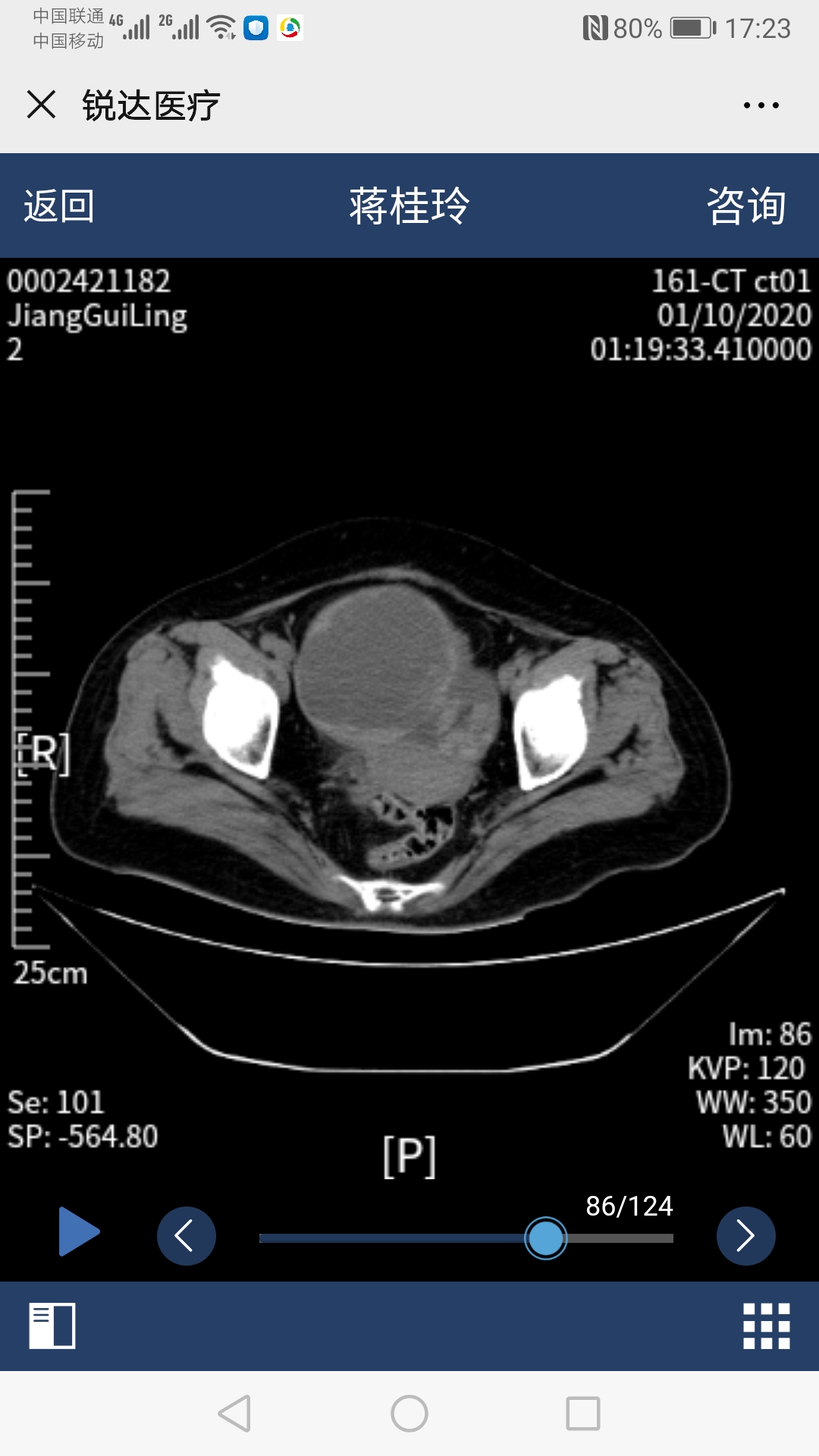 鍏堝績鐥呭悎骞舵紡鏂楄兏鎵嬫湳,瀹吂鑱斿悎鍥婅偪鎵嬫湳