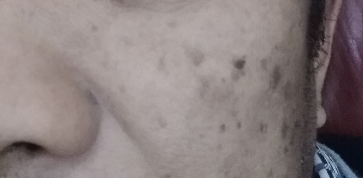 油溅到脸上有黑斑多久消失图片,脸上被太阳晒的黑斑怎么去除