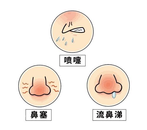 儿童过敏性鼻炎合并哮喘用什么药,治疗过敏性鼻炎有效的药儿童