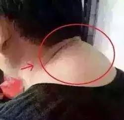 颈椎突出跟增生有什么症状,颈椎开始有病是什么前兆