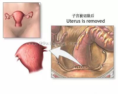 子宫切除术出院后吃什么最好,做了子宫切除术需要注意哪些