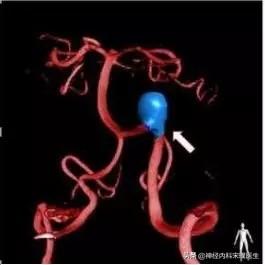 左头顶一跳一跳的痛偏头痛,偏头痛头皮一跳一跳疼怎么缓解