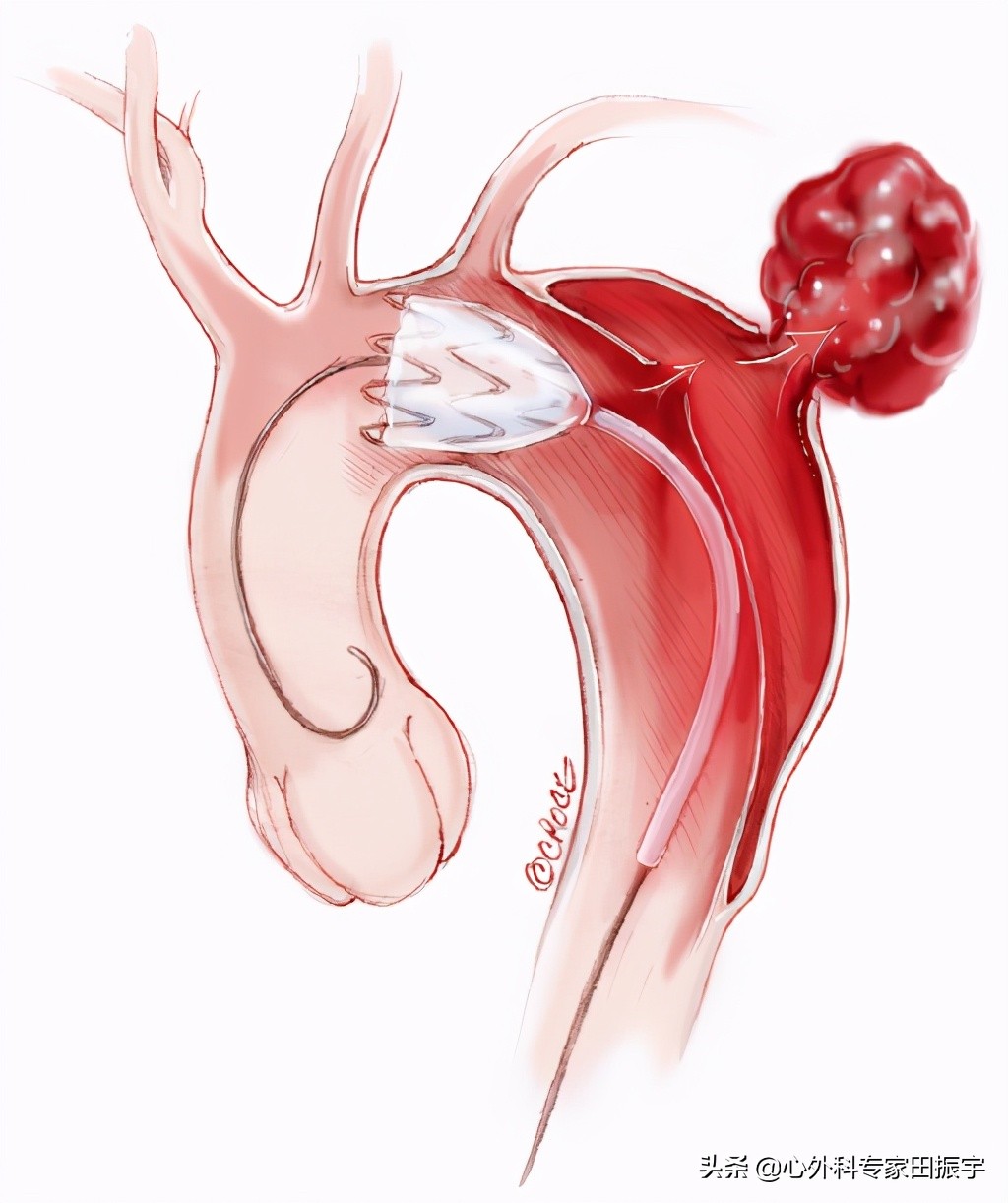 急性B型主动脉夹层合并主动脉破裂的急诊处理