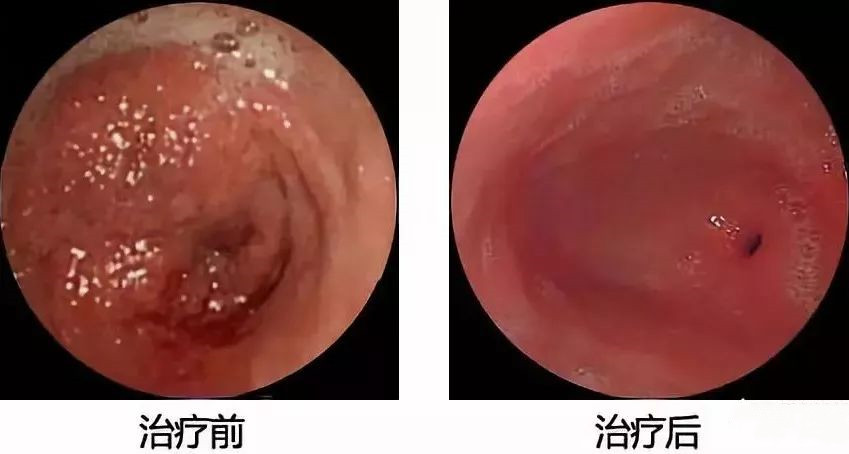 糜烂性胃炎不治能自愈吗,糜烂性胃炎不治会怎样