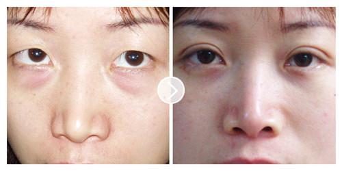 做完眼袋手术有淤青发黑怎么回事,做完眼袋手术有淤青图片