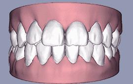 戴一个牙套牙会黑吗,戴个牙套有什么用处