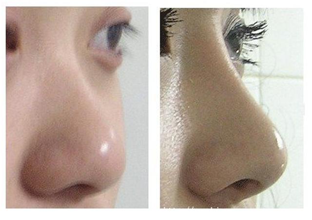 鼻子本身基础好的做隆鼻区别大吗,鼻子更高更立体