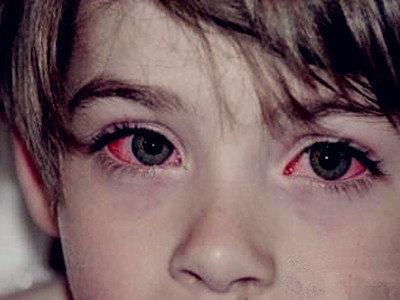 儿童结膜炎一般要多久能症状减轻,结膜炎症状减轻又严重了怎么回事