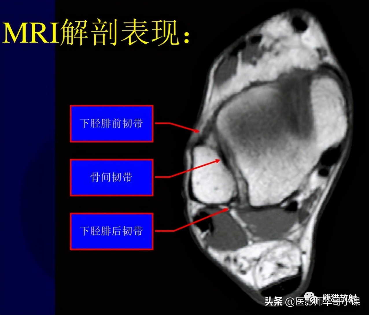 踝关节解剖视频课,解剖学韧带分布图