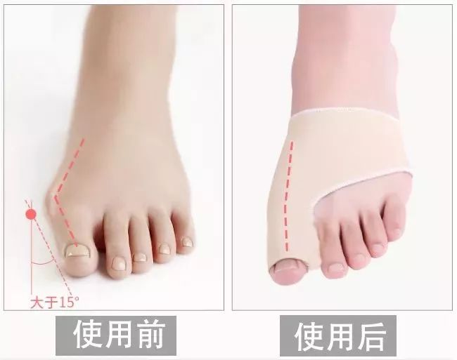 脚趾超级痛,轻度脚趾外翻如何矫正
