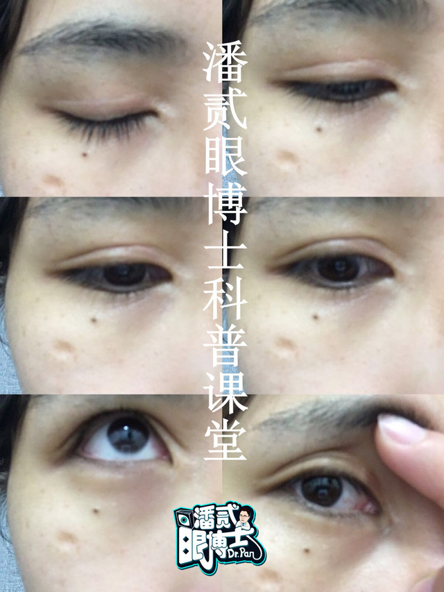 欧式大双眼皮和平行双眼皮,醒醒吧明智的放弃胜过盲目的执着