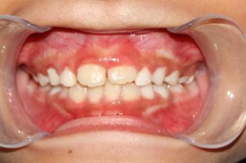 8岁的孩子能做牙齿矫正吗,7岁孩子矫正牙齿早吗