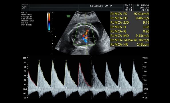 腹中胎儿水肿还能要吗,胎儿rh溶血症的解决方法